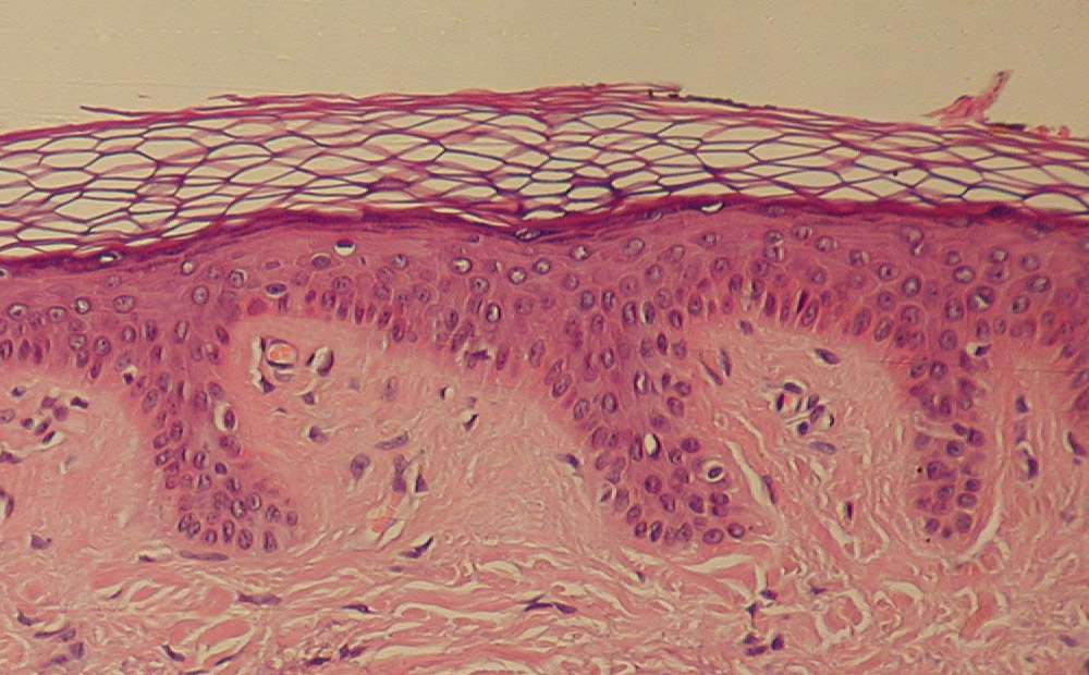 Normal Epidermis And Dermis With Intradermal Nevus 10X Cropped